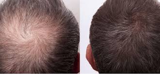 Hollywood Lace Introduces Innovative Lace/Skin Hybrid Hair System for Men